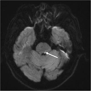 Case report: A variant of wall-eyed bilateral internuclear ophthalmoplegia from unilateral pons infarction